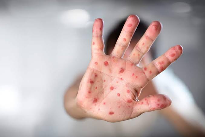 13 Students Infected With Hand, Foot, And Mouth Disease In Srinagar School