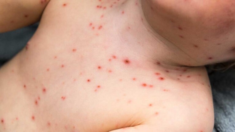 Measles Virus Outbreak At Farkin Village In Kupwara